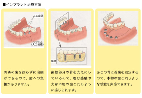 インプラントの治療方法