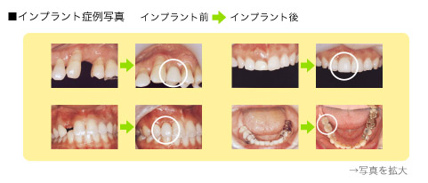 インプラント症例写真